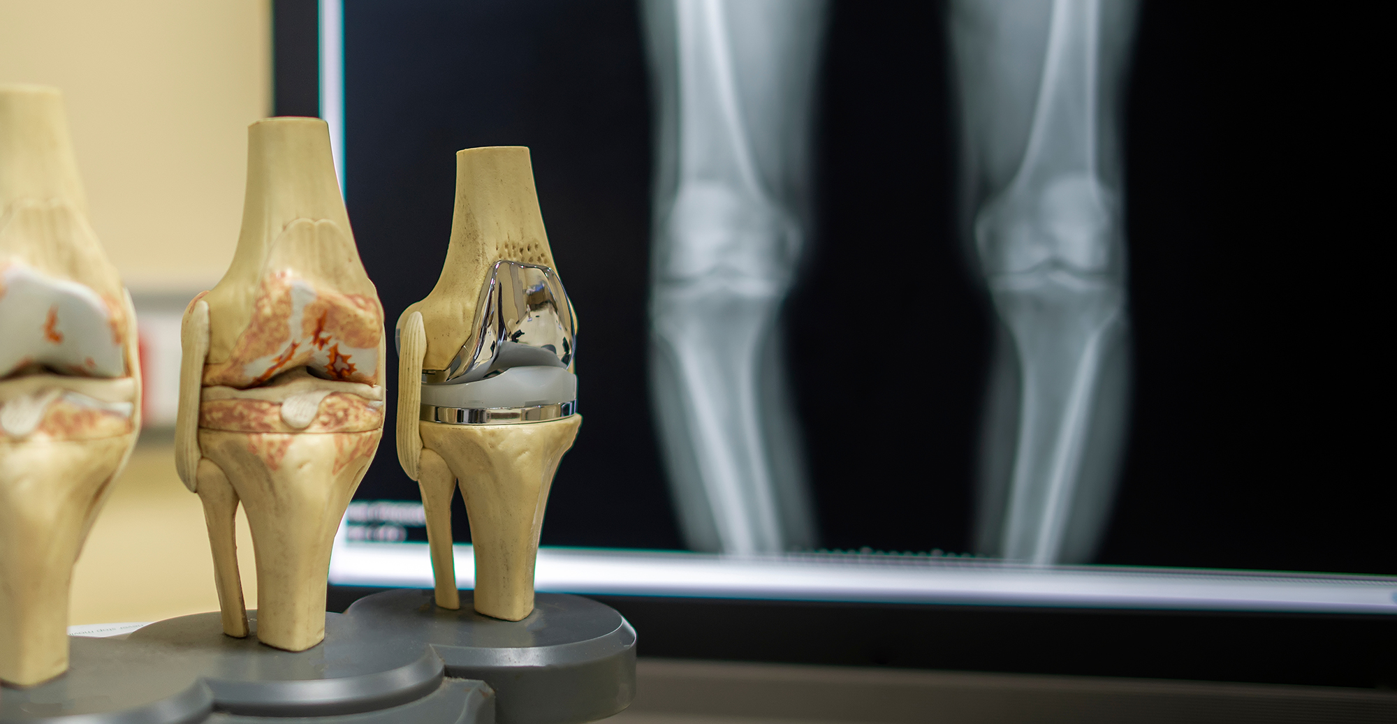 Artificial knee replacement surgery